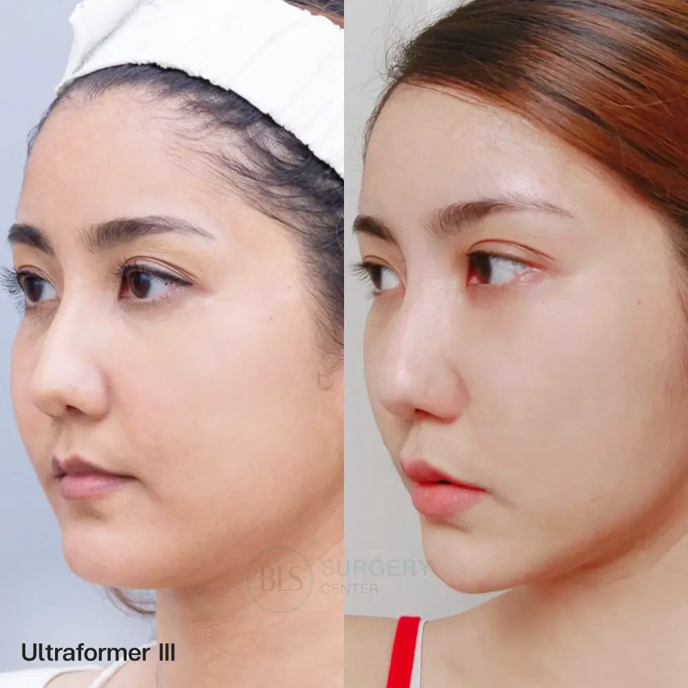รีวิว Ultraformer III