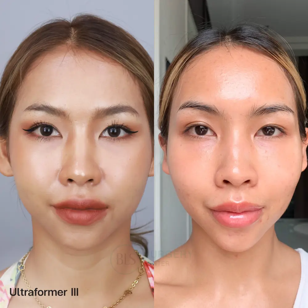 รีวิว Ultraformer III