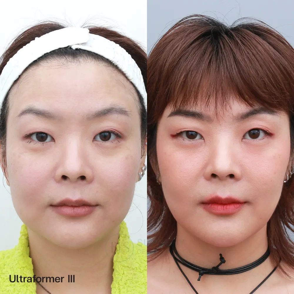 รีวิว Ultraformer III