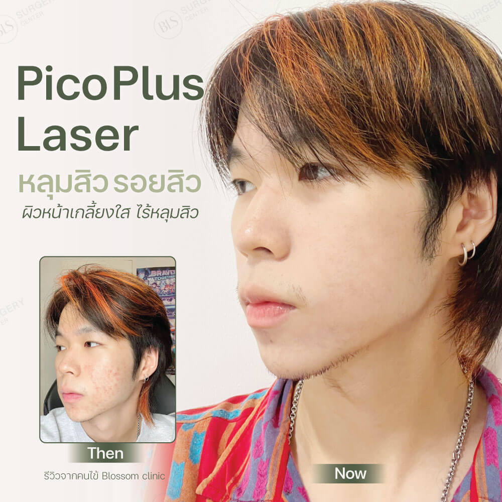 Pico Plus Laser หลุมสิวรอยสิว