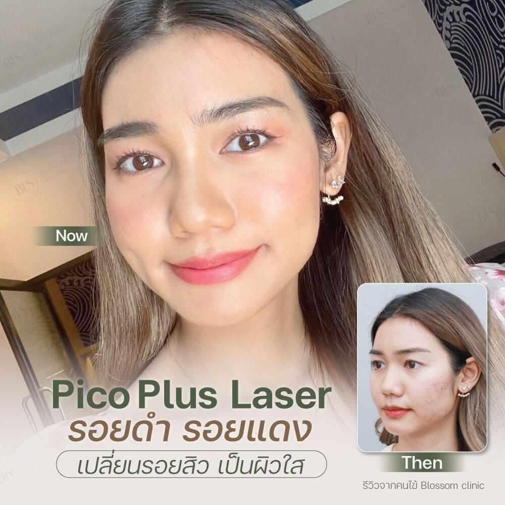 Pico Laser รอยดำ รอยแดง เปลี่ยนรอยสิว เป็นผิวใส