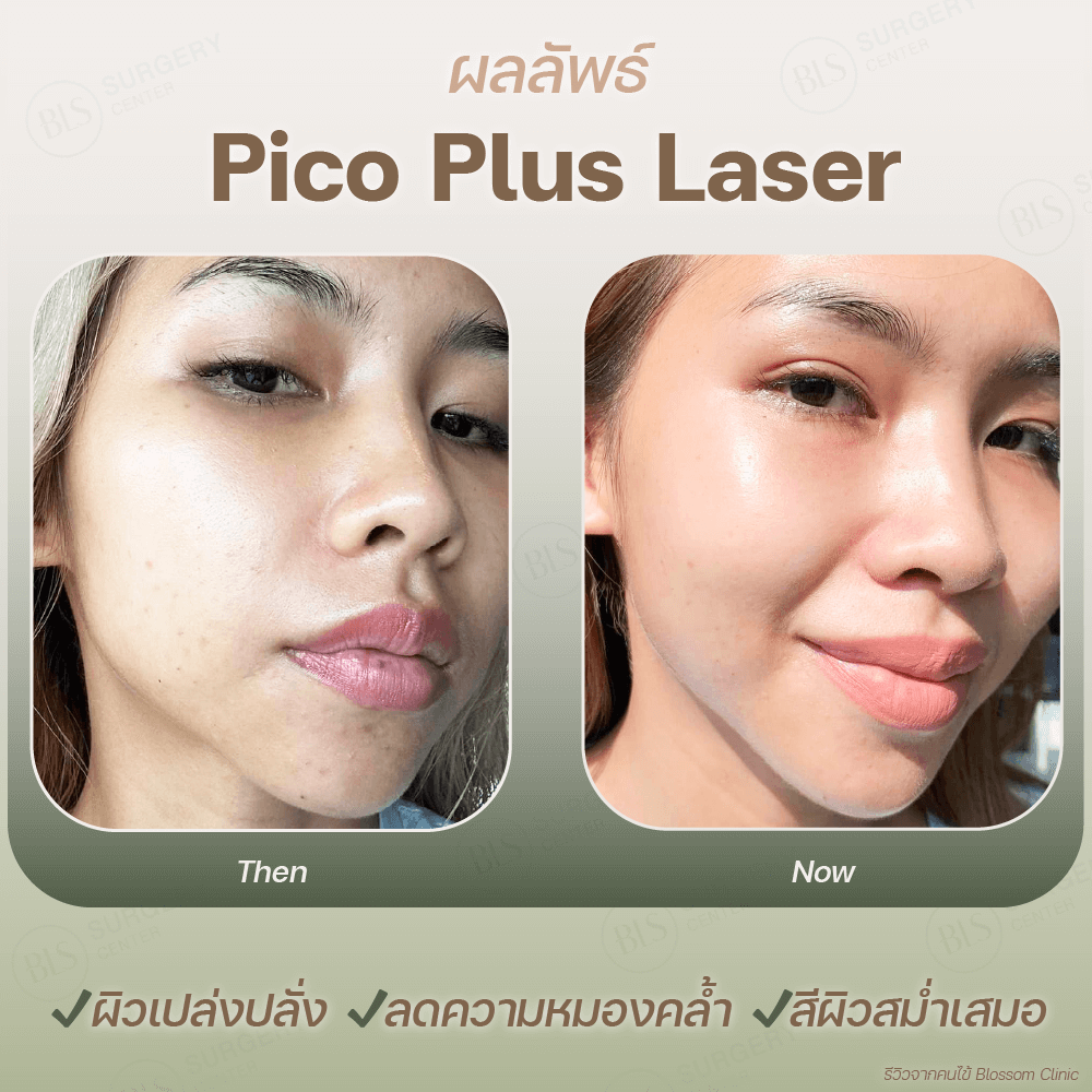 ผลลัพธ์ Pico Plus Laser