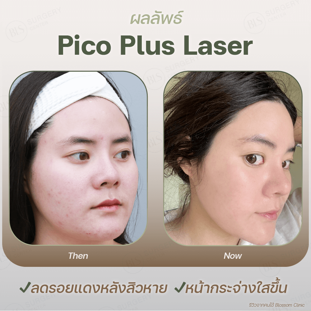 ผลลัพธ์ Pico Plus Laser