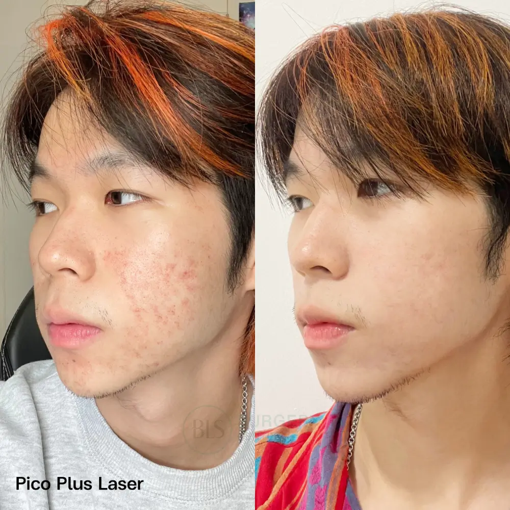 รีวิว Pico Plus Laser