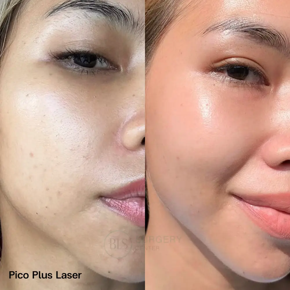 รีวิว Pico Plus Laser