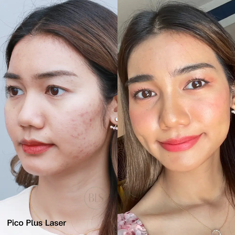 รีวิว Pico Plus Laser