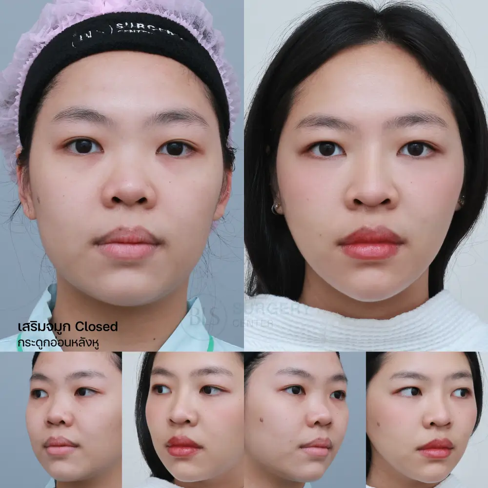 เสริมจมูก เทคนิค closed กระดูกอ่อนหลังหู
