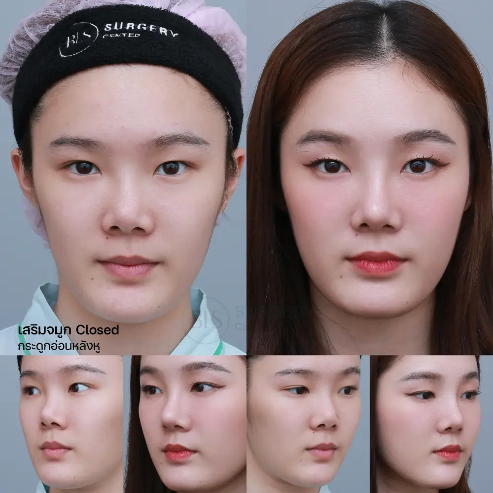 เสริมจมูก เทคนิค Closed กระดูกอ่อนหลังหู