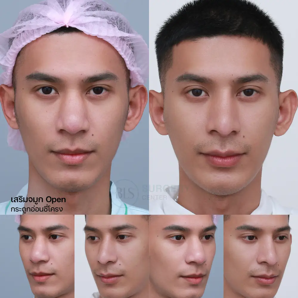 เสริมจมูก เทคนิค Open กระดูกอ่อนซี่โครง