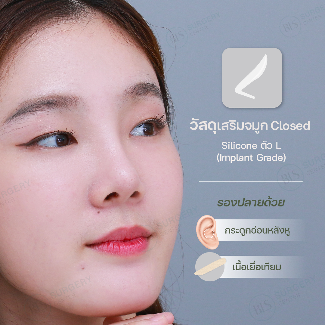 วัสดุที่ใช้ในการ เสริมจมูก เทคนิค Closed