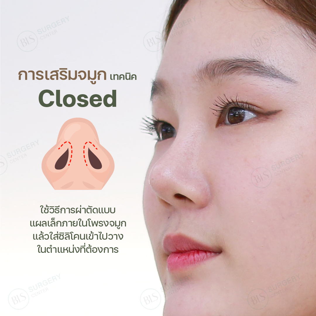 การ เสริมจมูก (Rhinoplasty) เทคนิค Closed คืออะไร? หมอบีม Facial Expert มีคำตอบ