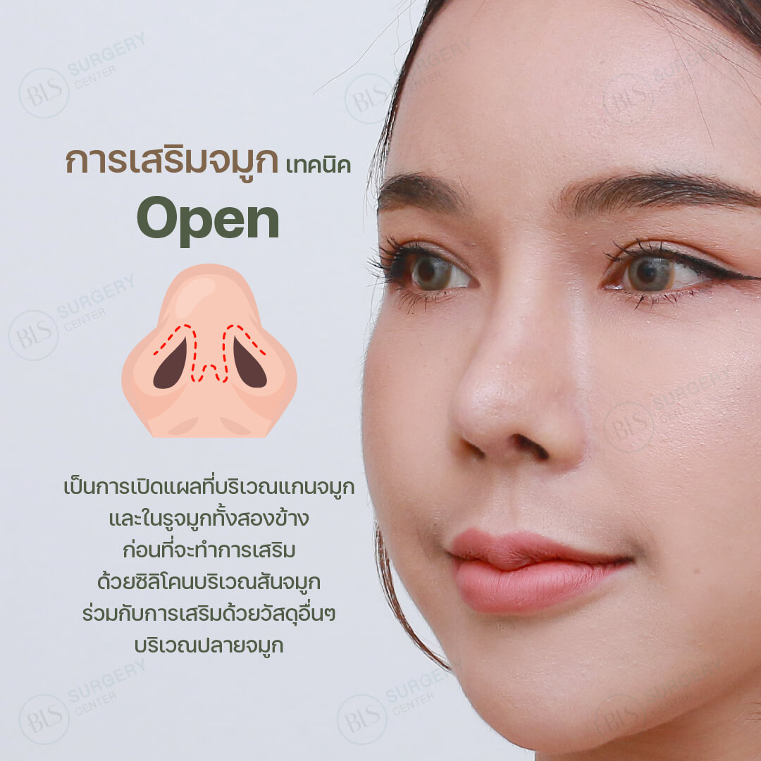 การ เสริมจมูก (Rhinoplasty) เทคนิค Open คืออะไร?
