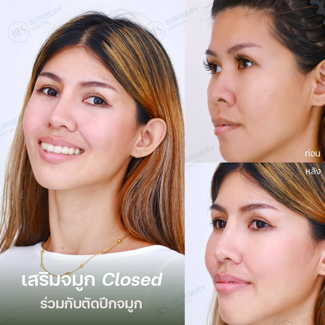 การเสริมจมูกเทคนิค Closed ร่วมกับตัดปีกจมูก