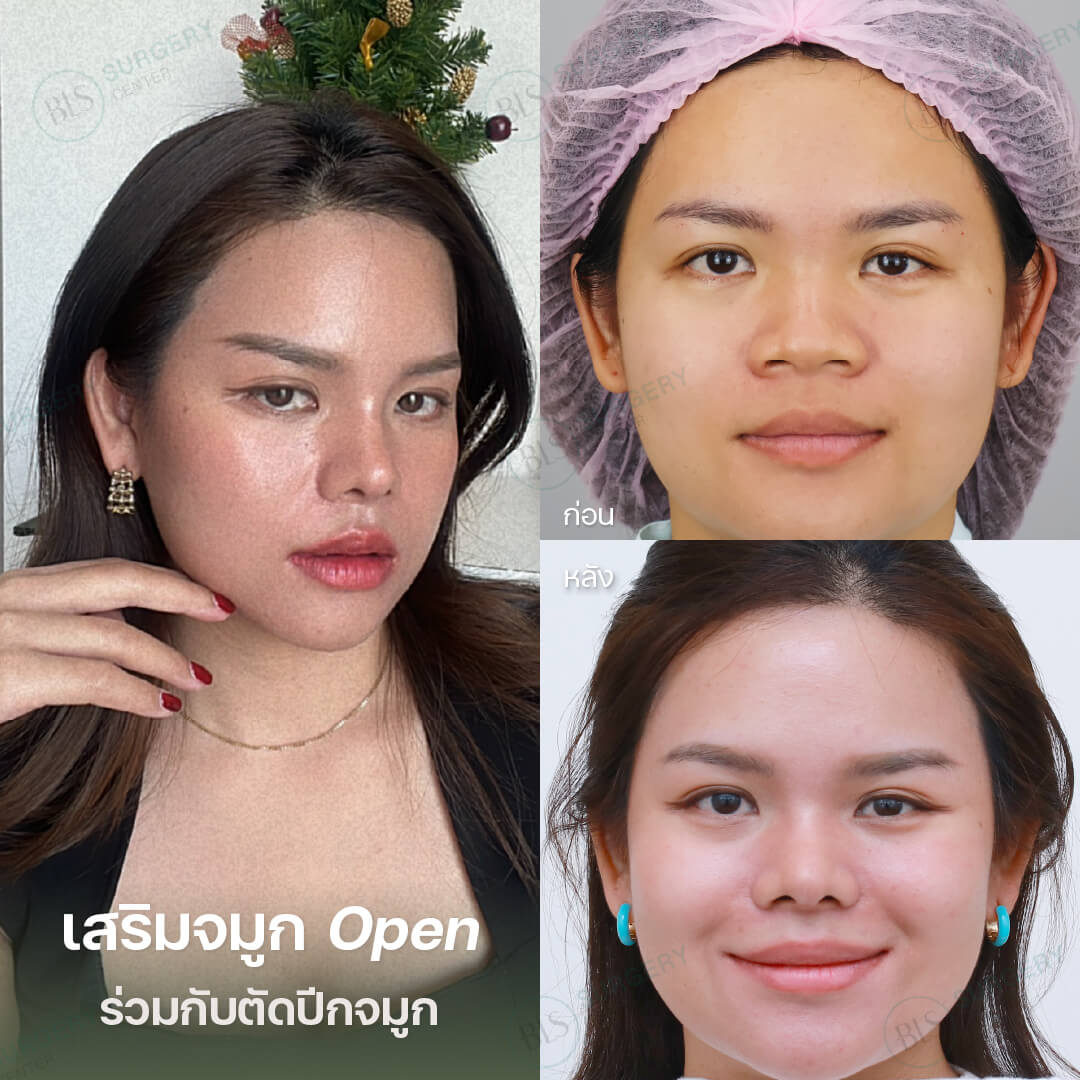 เสริมจมูก แบบโอเพ่น ร่วมกับการตัดปีกจมูก