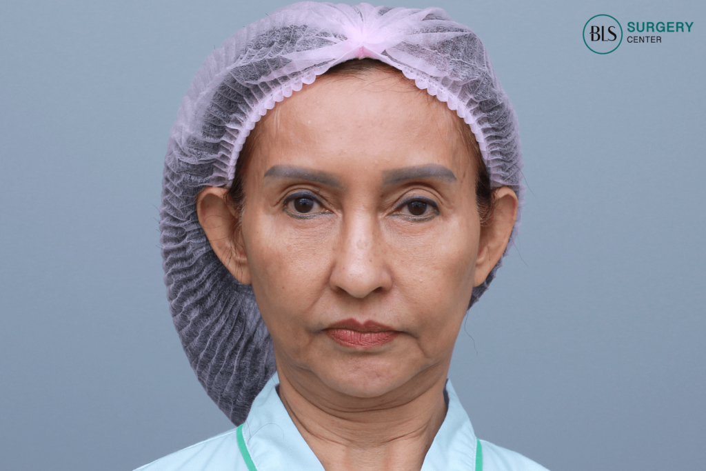 Face lift ผ่าตัดดึงหน้า เหมาะกับใครบ้าง? 