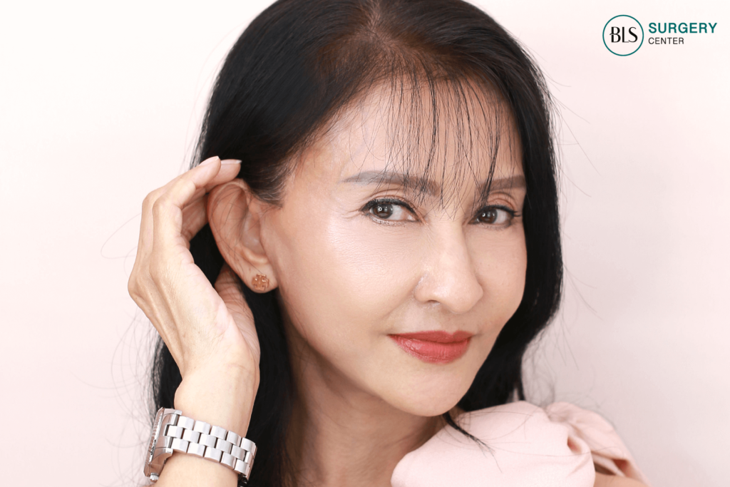 หลังดึงหน้า (Face lift) + ยกกระชับลำคอ (Neck Lift) 3 เดือน