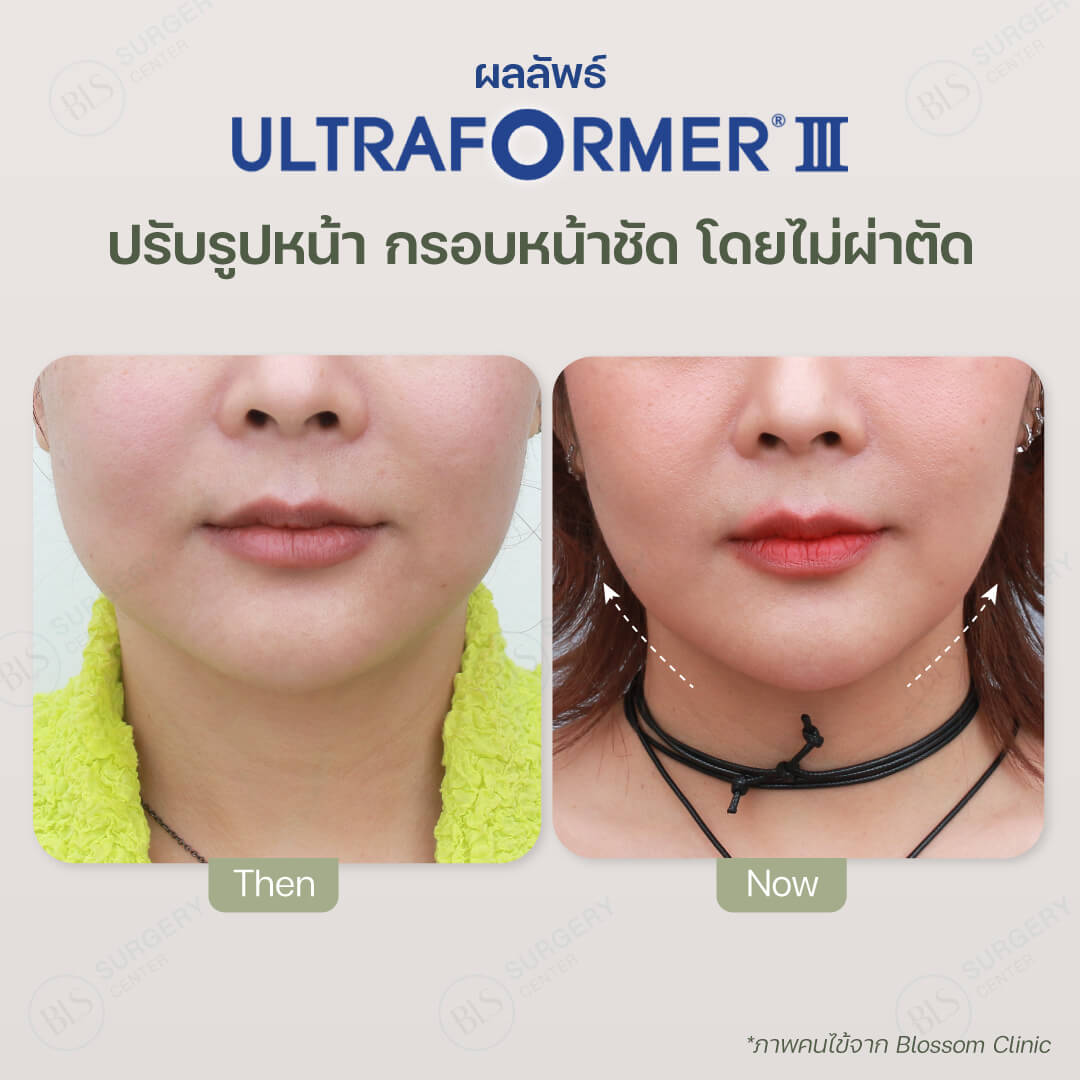 Ultraformer III เหมาะกับใคร?