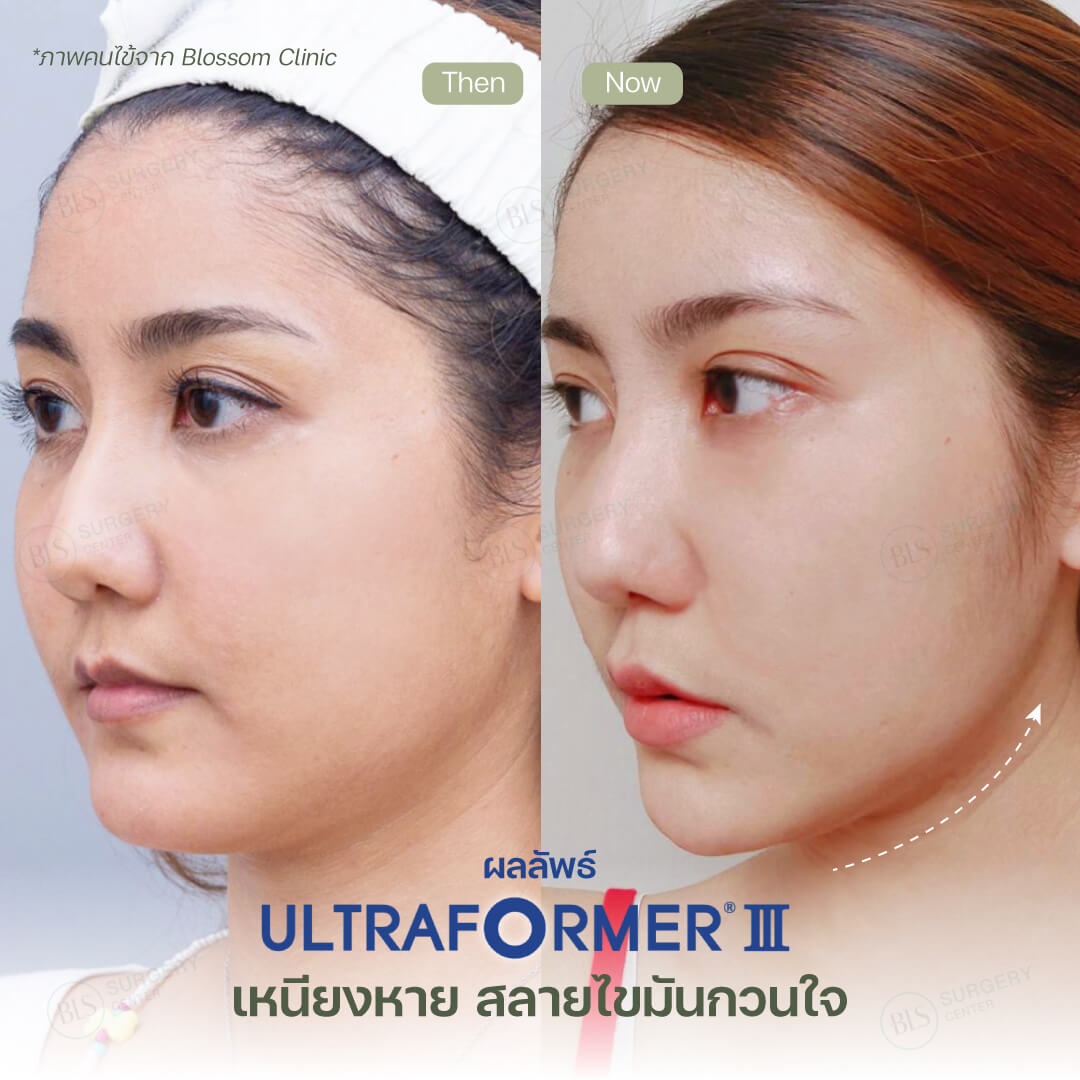 Ultraformer III เหมาะกับใคร?
