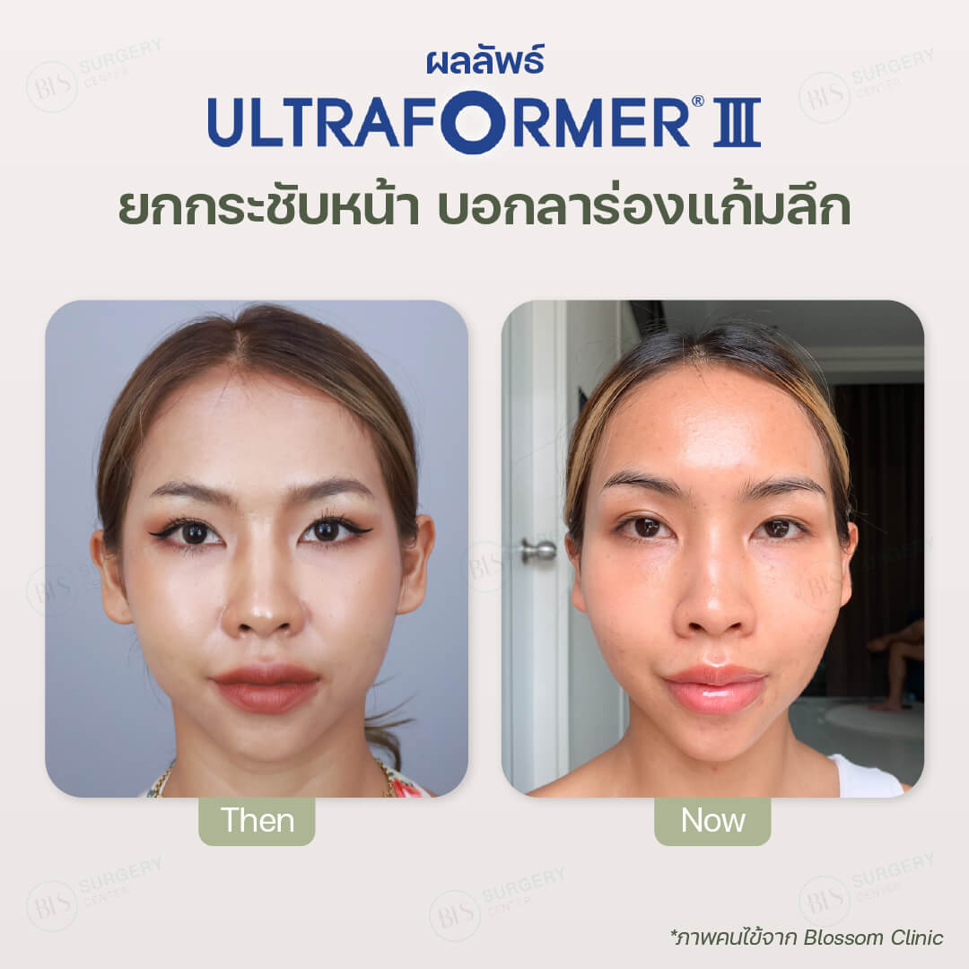 Ultraformer III เหมาะกับใคร?​