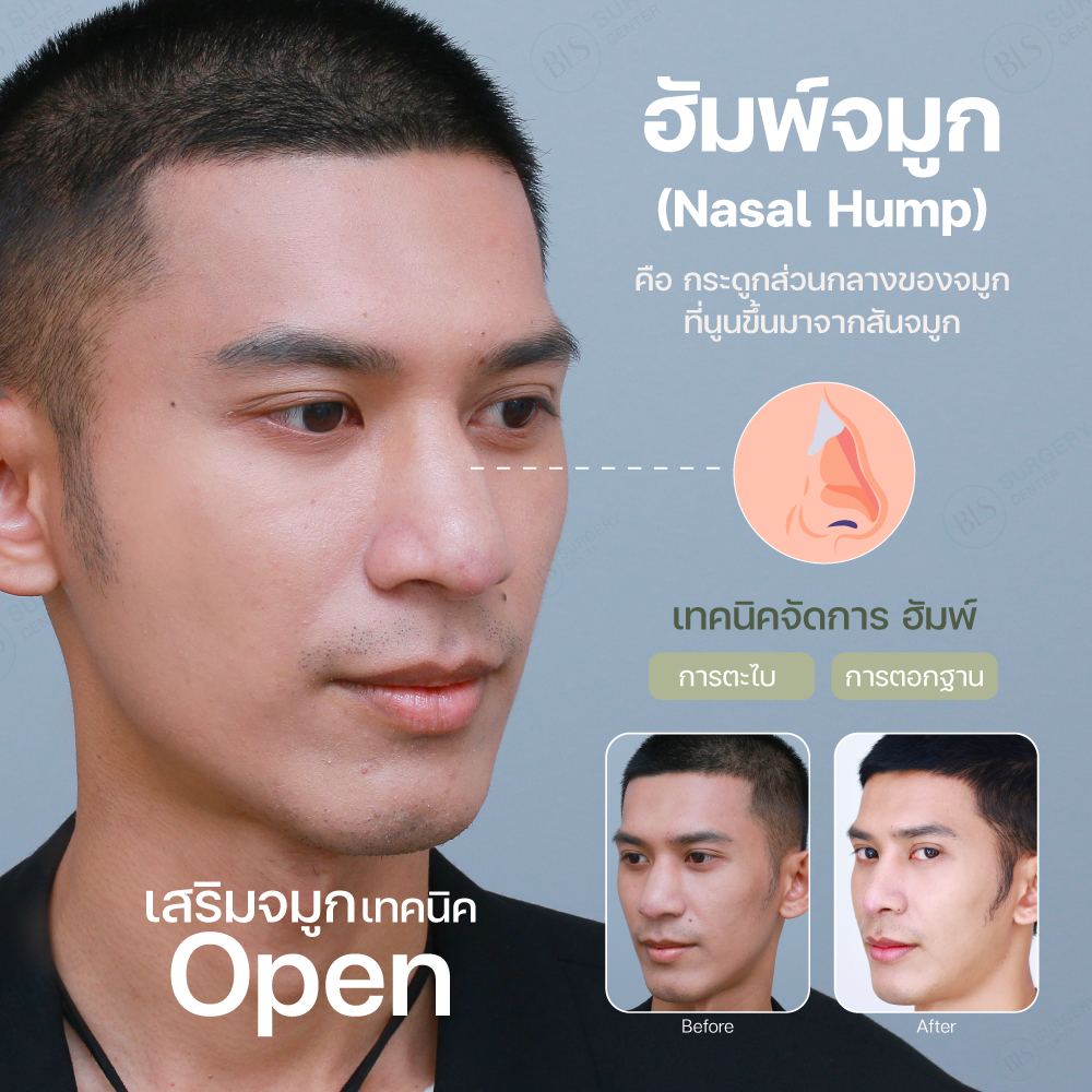 จมูกมีฮัมพ์ ควรเสริมจมูกด้วยเทคนิคอะไร?