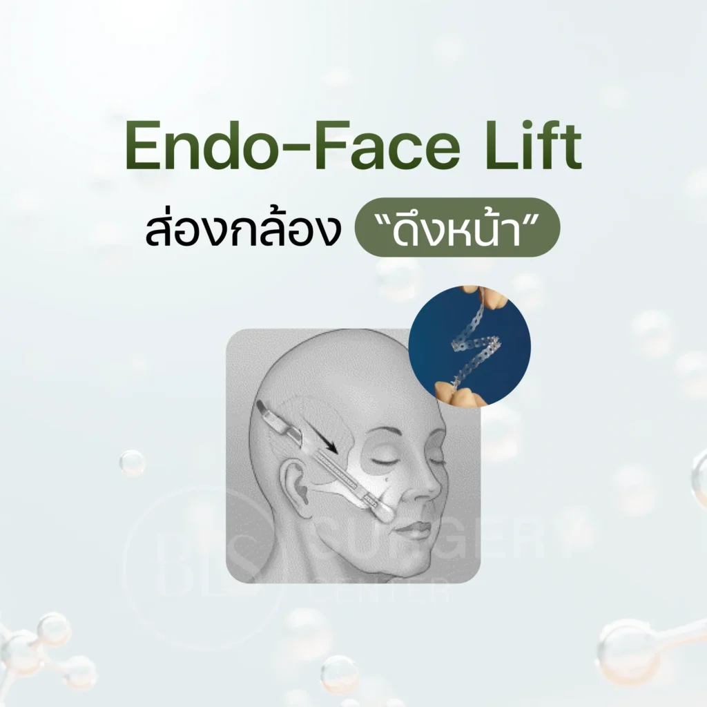 Endo face lift ส่องกล้อง "ดึงหน้า"