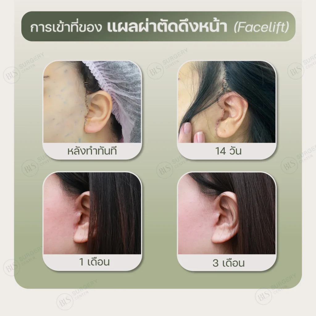 ดึงหน้าที่ไหนดี? ดึงหน้ากับหมอบีม Facial Expert ซ่อนแผลเนียนจนมองไม่เห็น