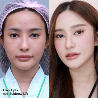 รีวิว ดึงหน้า แก้หน้าหย่อนคล้อย (FACELIFT)