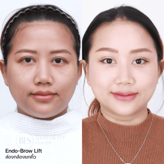 รีวิว แก้คิ้วตก ตาตก ส่องกล้องยกคิ้ว (ENDO-BROW LIFT)