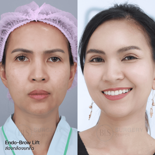 รีวิว แก้คิ้วตก ตาตก ส่องกล้องยกคิ้ว (ENDO-BROW LIFT)